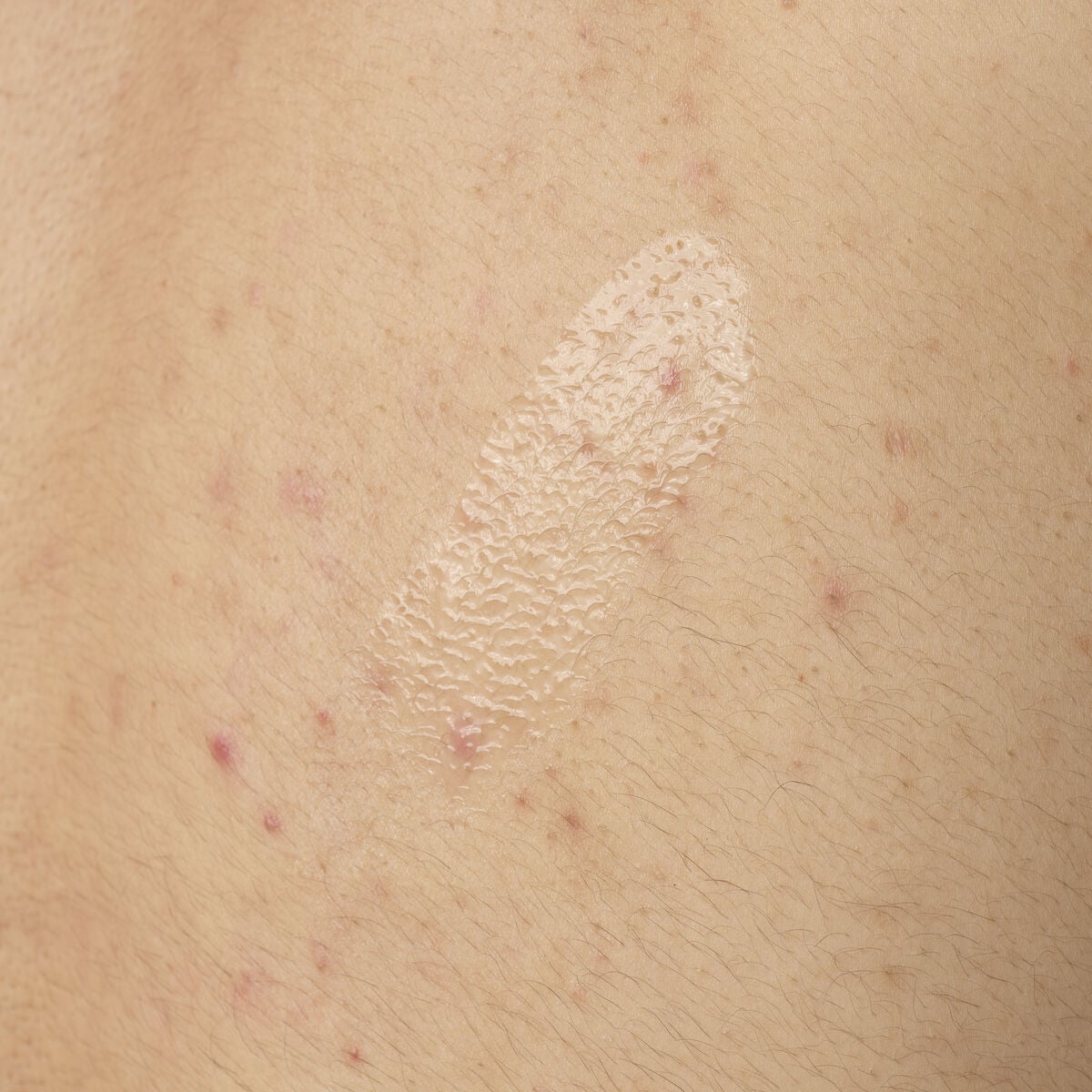 salicylic-acid-0-5-body-serum-e7 ORD-salicylic-acid-05-body-240ml-application.jpg
