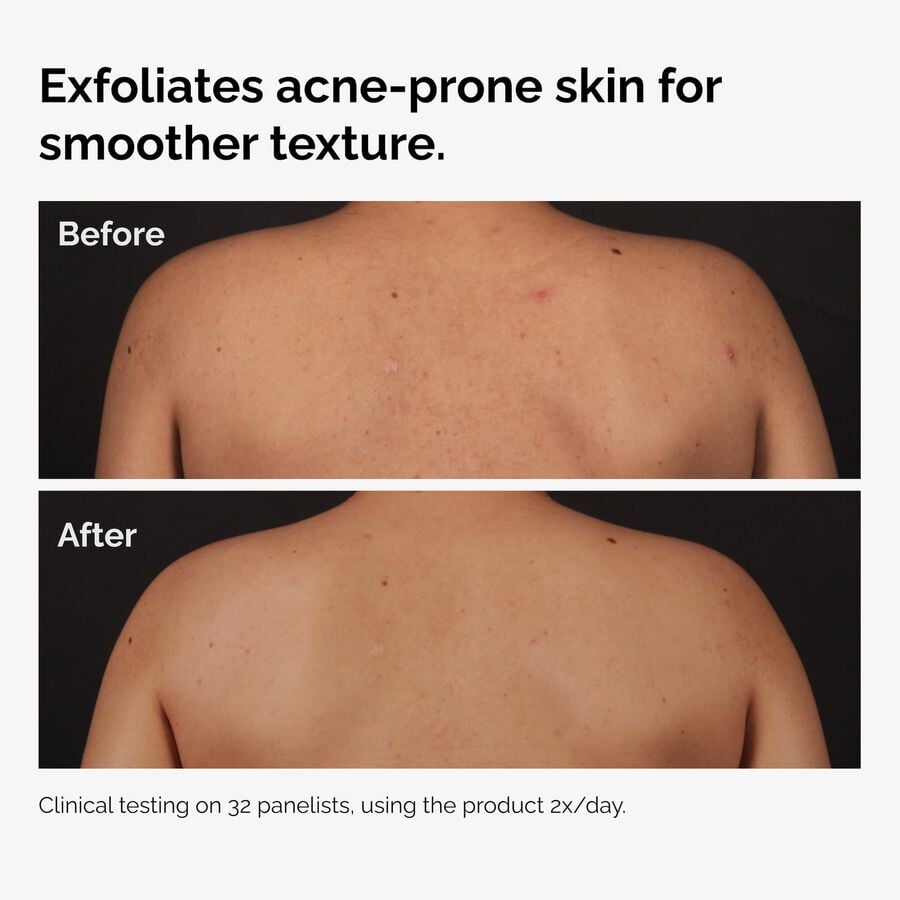 salicylic-acid-0-5-body-serum-o5 ord-salicylic-acid-body-serum-before-after-graphic-NA.jpg