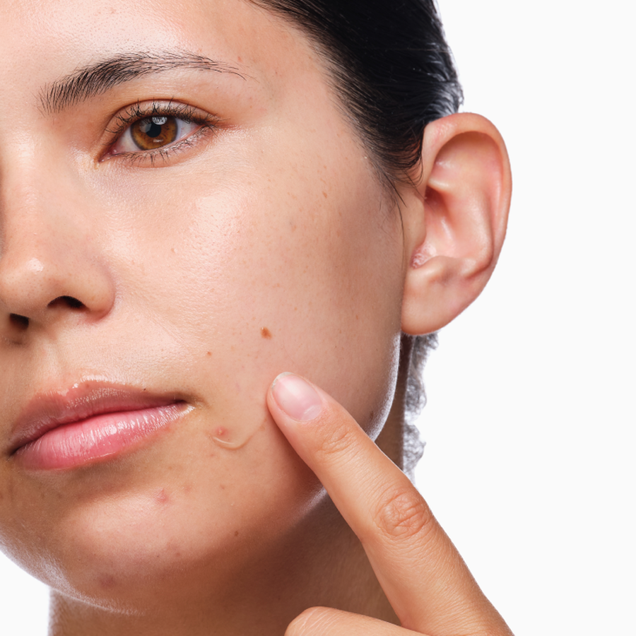 the-acne-set-j6 rdn-the-acne-set-application.png